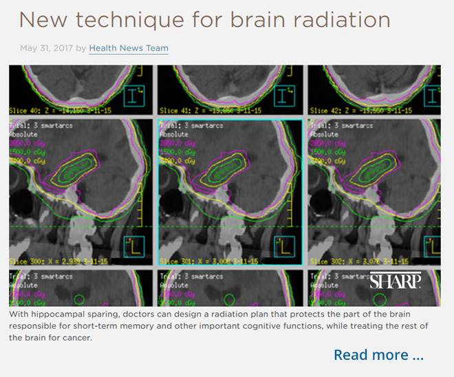 new technique for brain radiation